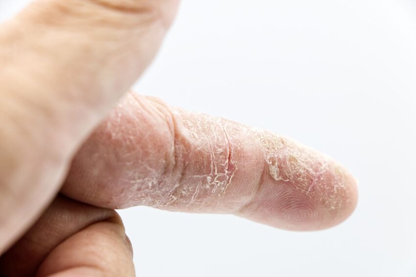 Diabetul de tip 2: Semne de alarmă pe piele și vindecarea lentă a rănilor